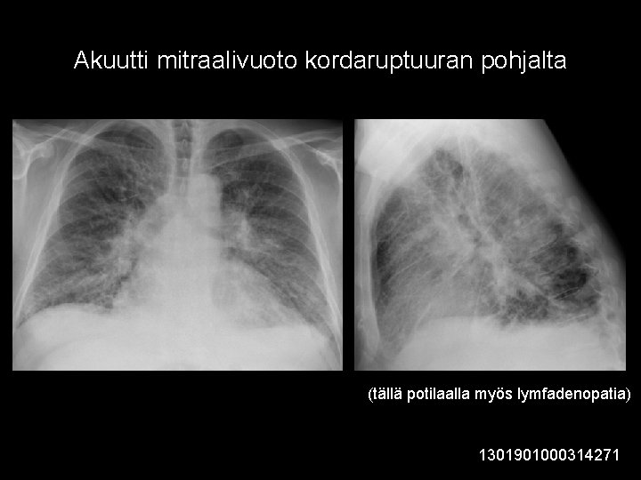 Akuutti mitraalivuoto kordaruptuuran pohjalta (tällä potilaalla myös lymfadenopatia) 1301901000314271 