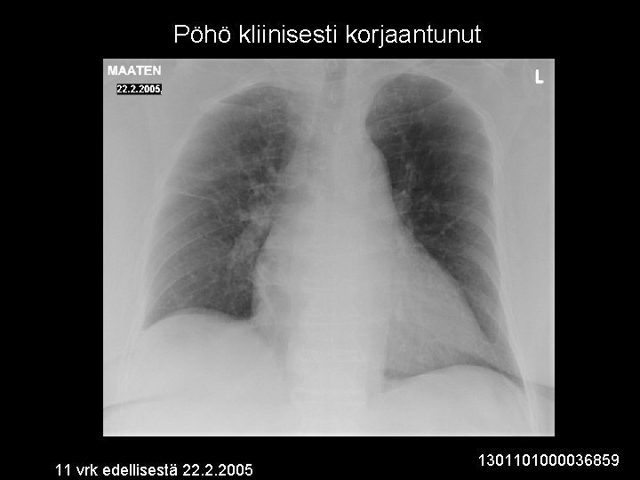 Pöhö kliinisesti korjaantunut 11 vrk edellisestä 22. 2. 2005 1301101000036859 