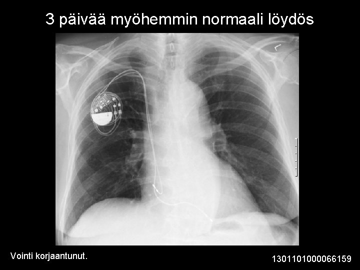 3 päivää myöhemmin normaali löydös Vointi korjaantunut. 1301101000066159 