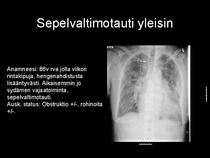 Sepelvaltimotauti yleisin Anamneesi: 86 v rva jolla viikon rintakipuja, hengenahdistusta lisääntyvästi. Aikaisemmin jo sydämen