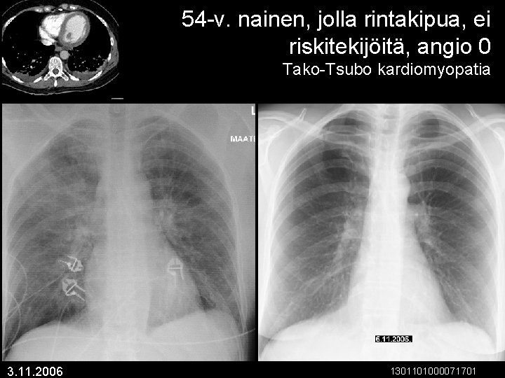 54 -v. nainen, jolla rintakipua, ei riskitekijöitä, angio 0 Tako-Tsubo kardiomyopatia 3. 11. 2006