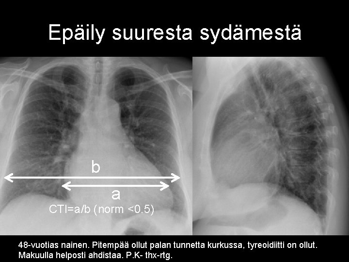 Epäily suuresta sydämestä b a CTI=a/b (norm <0. 5) 48 -vuotias nainen. Pitempää ollut