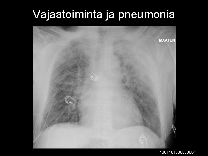 Vajaatoiminta ja pneumonia 1301101000053084 