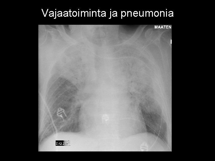 Vajaatoiminta ja pneumonia 