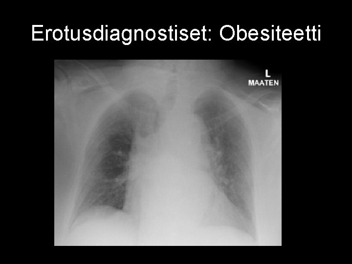 Erotusdiagnostiset: Obesiteetti 