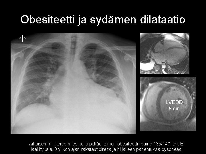 Obesiteetti ja sydämen dilataatio LVEDD 9 cm Aikaisemmin terve mies, jolla pitkäaikainen obesiteetti (paino