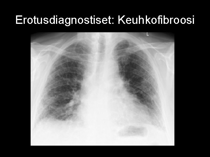 Erotusdiagnostiset: Keuhkofibroosi Erotusdiagnostiset: Keuhkofibroosi