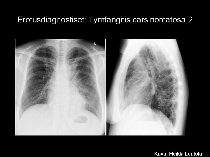 Erotusdiagnostiset: Lymfangitis carsinomatosa 2 Kuva: Heikki Leutola 