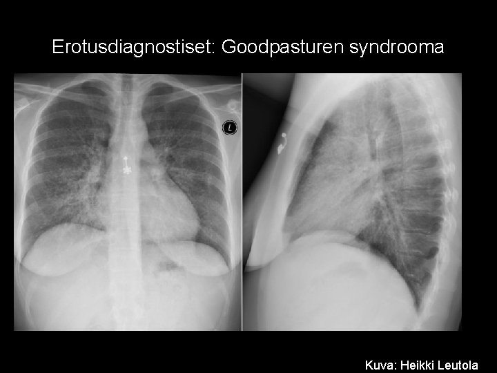 Erotusdiagnostiset: Goodpasturen syndrooma Kuva: Heikki Leutola 