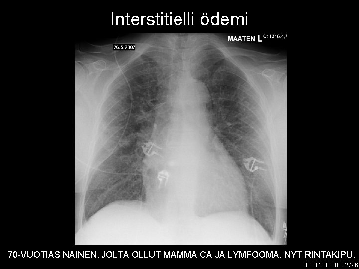 Interstitielli ödemi 70 -VUOTIAS NAINEN, JOLTA OLLUT MAMMA CA JA LYMFOOMA. NYT RINTAKIPU. 1301101000082796