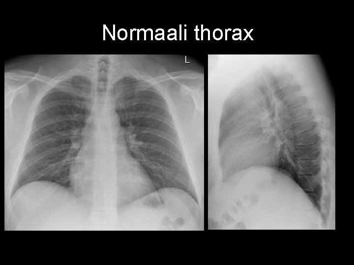 Normaali thorax 