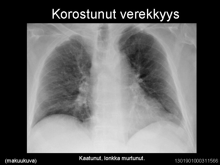 Korostunut verekkyys (makuukuva) Kaatunut, lonkka murtunut. 1301901000311566 