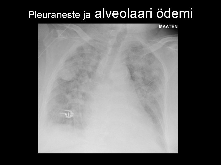 Pleuraneste ja alveolaari ödemi 