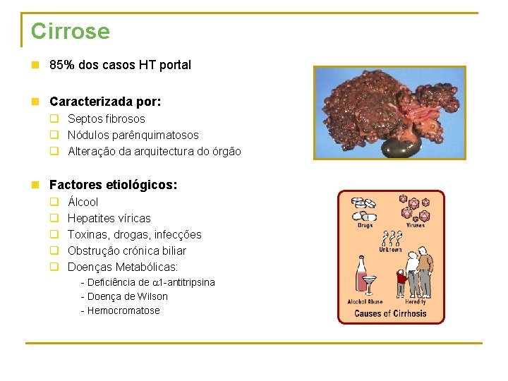 Cirrose n 85% dos casos HT portal n Caracterizada por: q Septos fibrosos q