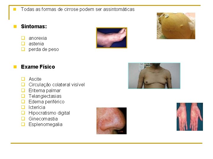 n Todas as formas de cirrose podem ser assintomáticas n Sintomas: q anorexia q