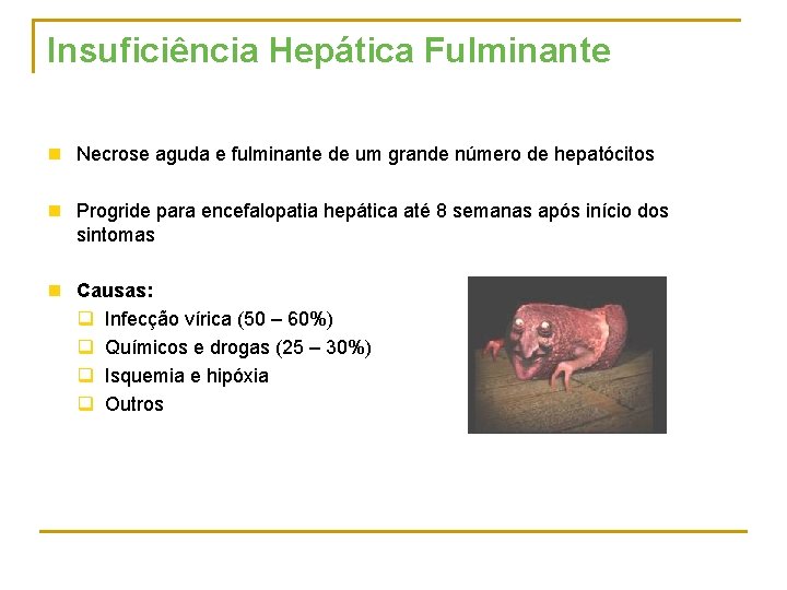 Insuficiência Hepática Fulminante n Necrose aguda e fulminante de um grande número de hepatócitos