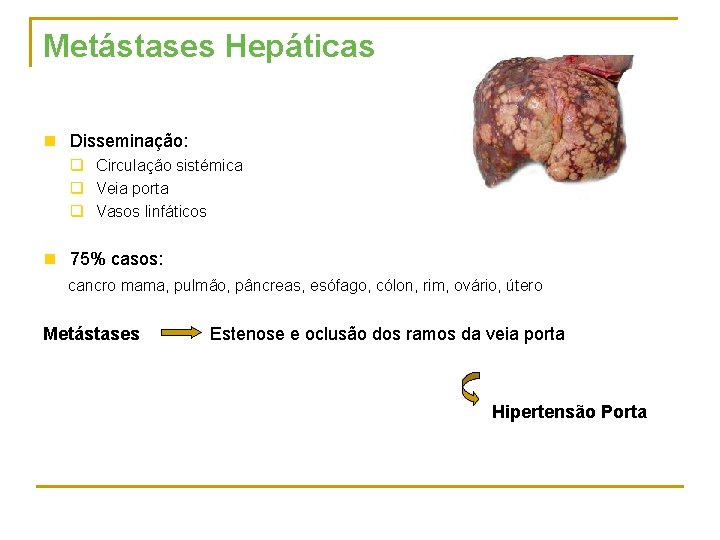Metástases Hepáticas n Disseminação: q Circulação sistémica q Veia porta q Vasos linfáticos n