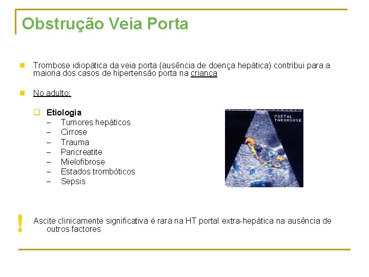 Obstrução Veia Porta n Trombose idiopática da veia porta (ausência de doença hepática) contribui