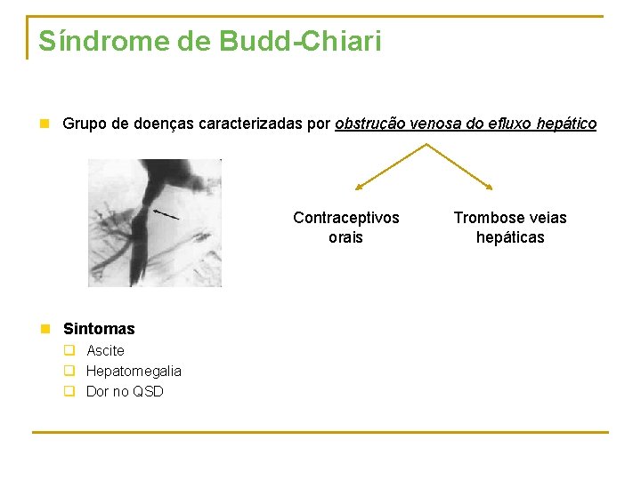 Síndrome de Budd-Chiari n Grupo de doenças caracterizadas por obstrução venosa do efluxo hepático