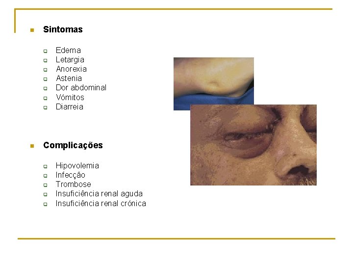 n Sintomas q q q q n Edema Letargia Anorexia Astenia Dor abdominal Vómitos