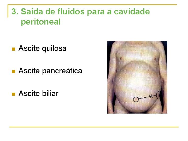 3. Saída de fluidos para a cavidade peritoneal n Ascite quilosa n Ascite pancreática