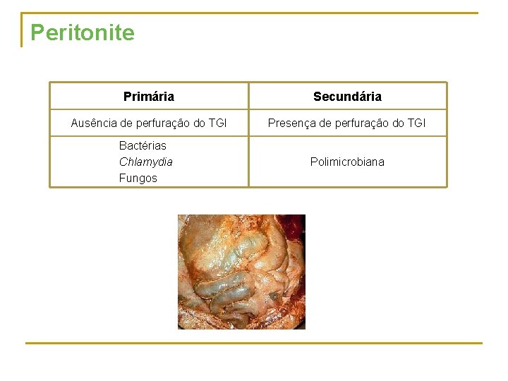 Peritonite Primária Secundária Ausência de perfuração do TGI Presença de perfuração do TGI Bactérias
