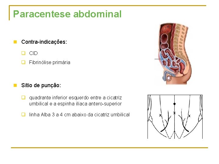 Paracentese abdominal n Contra indicações: q CID q Fibrinólise primária n Sítio de punção: