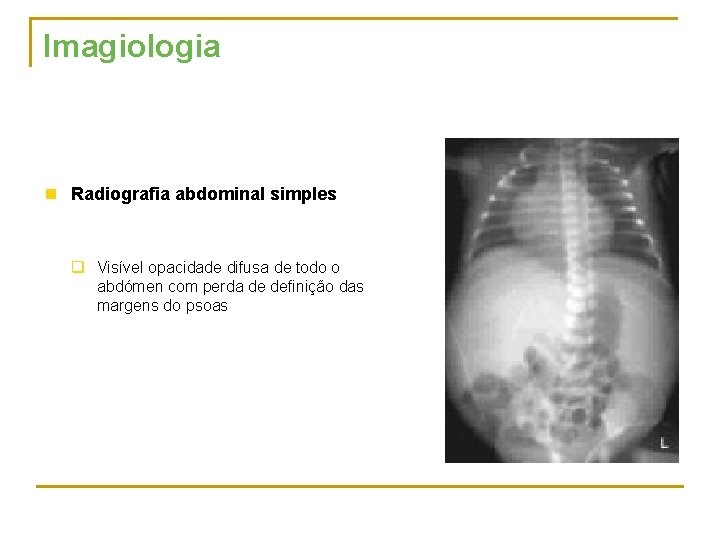 Imagiologia n Radiografia abdominal simples q Visível opacidade difusa de todo o abdómen com