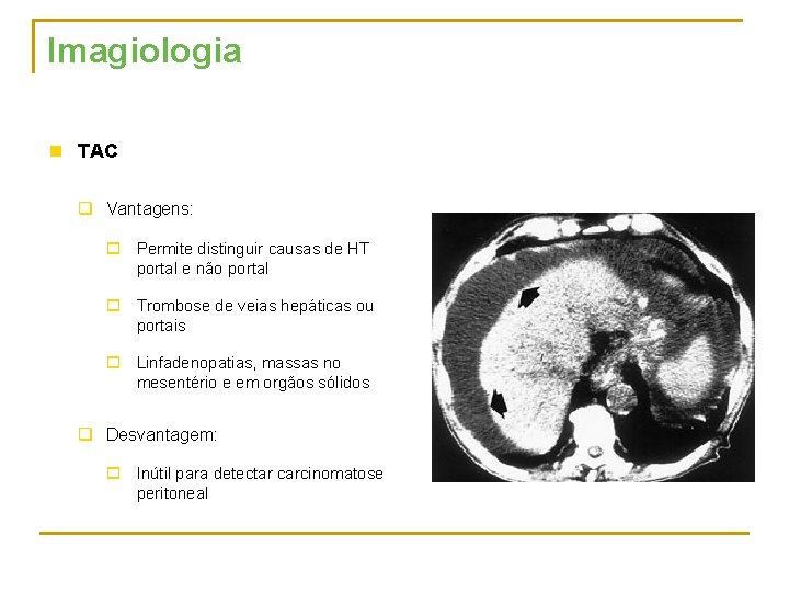 Imagiologia n TAC q Vantagens: o Permite distinguir causas de HT portal e não