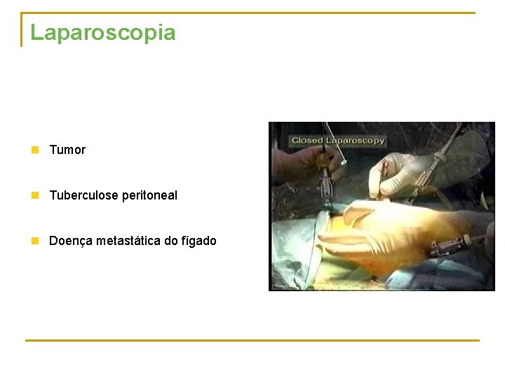 Laparoscopia n Tumor n Tuberculose peritoneal n Doença metastática do fígado 