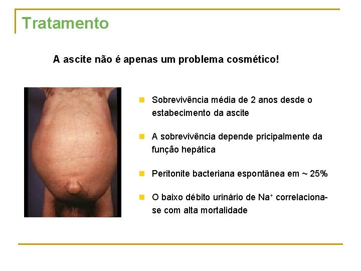 Tratamento A ascite não é apenas um problema cosmético! n Sobrevivência média de 2