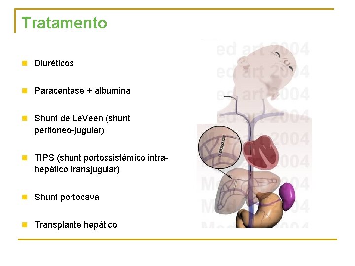 Tratamento n Diuréticos n Paracentese + albumina n Shunt de Le. Veen (shunt peritoneo