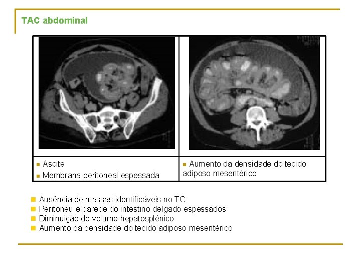 TAC abdominal Ascite n Membrana peritoneal espessada n Aumento da densidade do tecido adiposo