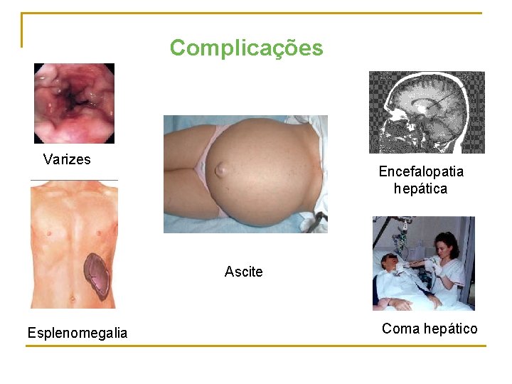 Complicações Varizes Encefalopatia hepática Ascite Esplenomegalia Coma hepático 