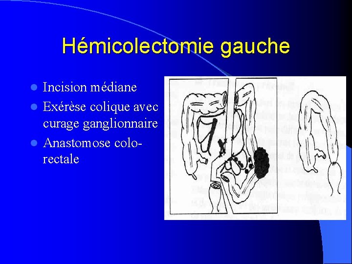 Hémicolectomie gauche Incision médiane l Exérèse colique avec curage ganglionnaire l Anastomose colorectale l