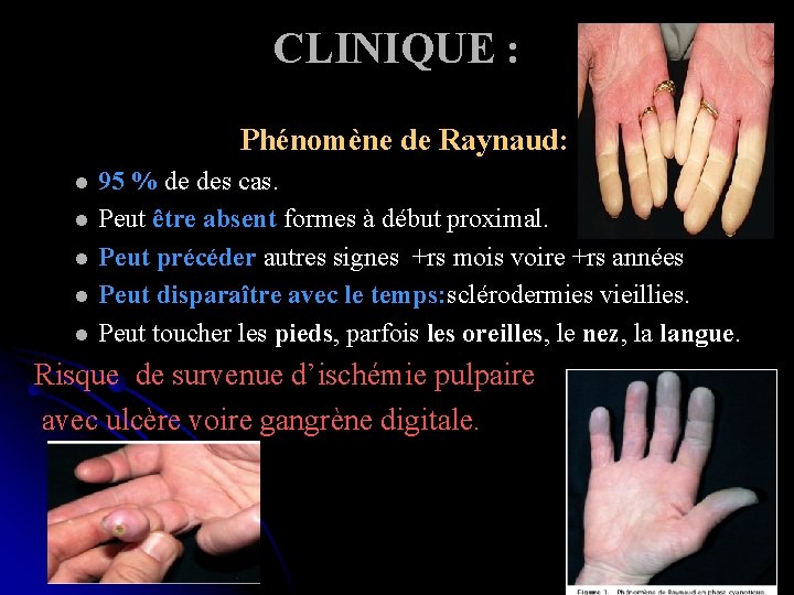 CLINIQUE : Phénomène de Raynaud: l l l 95 % de des cas. Peut