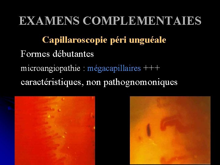 EXAMENS COMPLEMENTAIES Capillaroscopie péri unguéale Formes débutantes microangiopathie : mégacapillaires +++ caractéristiques, non pathognomoniques