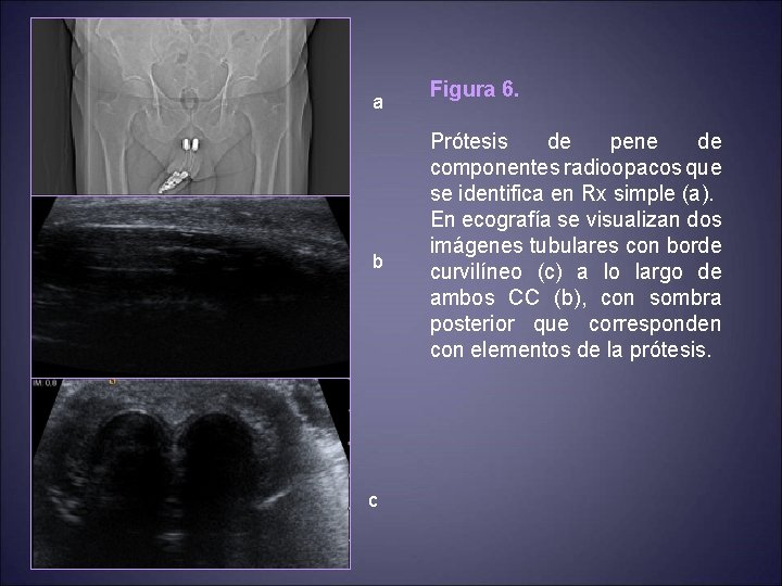 a b c Figura 6. Prótesis de pene de componentes radioopacos que se identifica