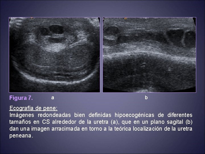 Figura 7. a b Ecografía de pene: Imágenes redondeadas bien definidas hipoecogénicas de diferentes