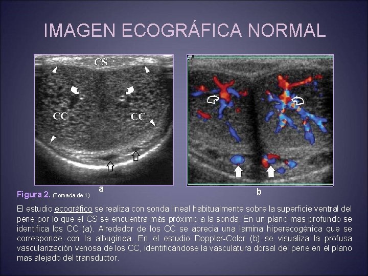 IMAGEN ECOGRÁFICA NORMAL Figura 2. (Tomada de 1). a b El estudio ecográfico se