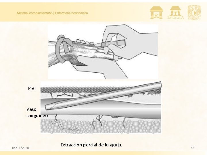 Piel Vaso sanguíneo 04/11/2020 Extracción parcial de la aguja. 46 