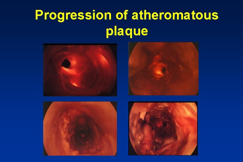 Progression of atheromatous plaque 