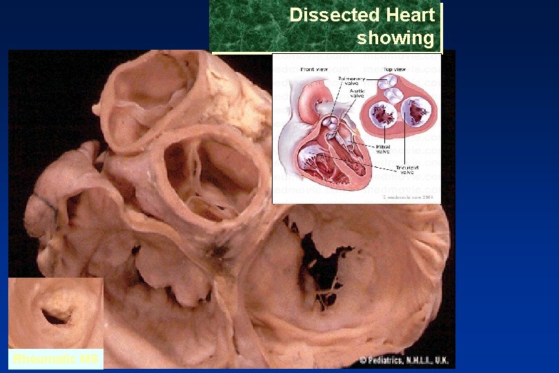 Dissected Heart showing Valve Openings Rheumatic MS 