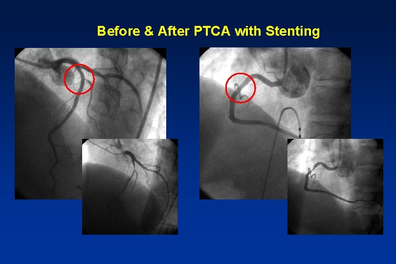 Before & After PTCA with Stenting 