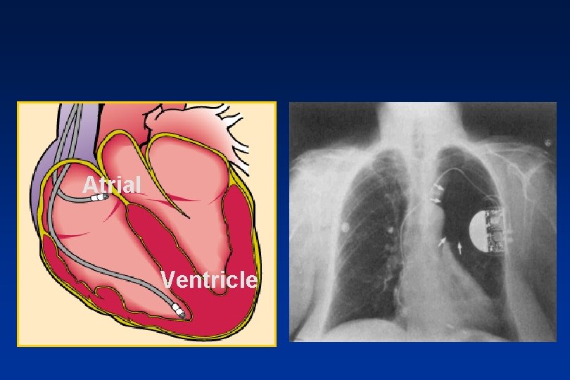 Atrial Ventricle 