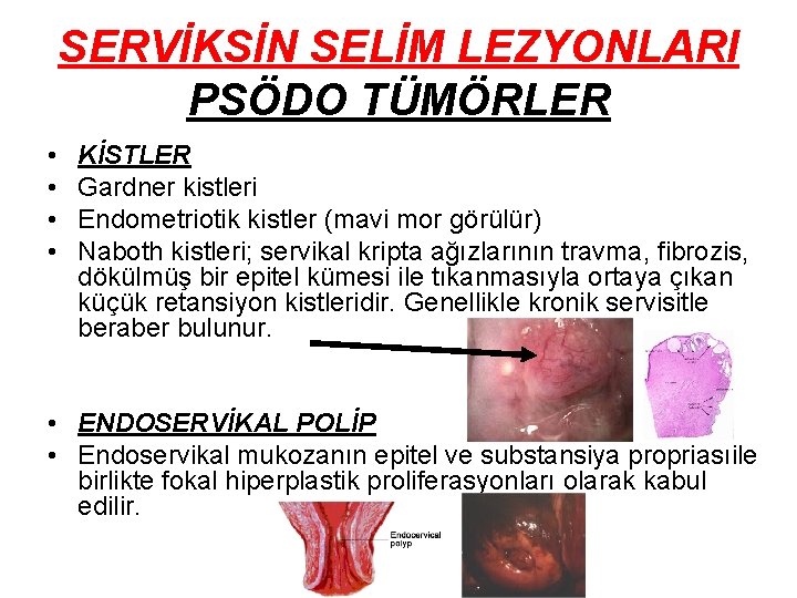 SERVİKSİN SELİM LEZYONLARI PSÖDO TÜMÖRLER • • KİSTLER Gardner kistleri Endometriotik kistler (mavi mor SERVİKSİN SELİM LEZYONLARI PSÖDO TÜMÖRLER • • KİSTLER Gardner kistleri Endometriotik kistler (mavi mor