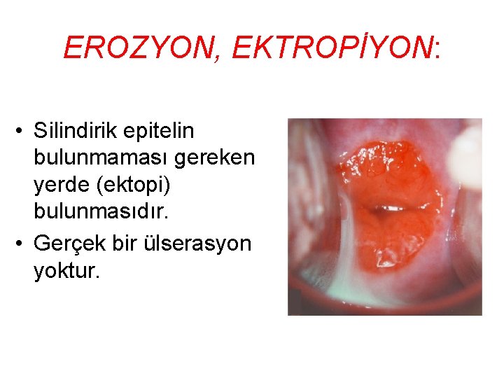 EROZYON, EKTROPİYON: • Silindirik epitelin bulunmaması gereken yerde (ektopi) bulunmasıdır. • Gerçek bir ülserasyon EROZYON, EKTROPİYON: • Silindirik epitelin bulunmaması gereken yerde (ektopi) bulunmasıdır. • Gerçek bir ülserasyon