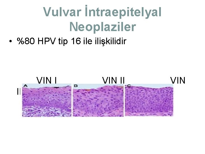 Vulvar İntraepitelyal Neoplaziler • %80 HPV tip 16 ile ilişkilidir VIN I III VIN Vulvar İntraepitelyal Neoplaziler • %80 HPV tip 16 ile ilişkilidir VIN I III VIN