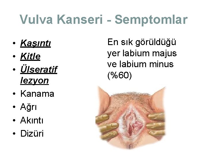 Vulva Kanseri - Semptomlar • Kaşıntı • Kitle • Ülseratif lezyon • Kanama • Vulva Kanseri - Semptomlar • Kaşıntı • Kitle • Ülseratif lezyon • Kanama •