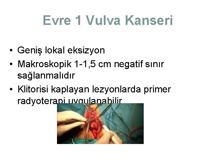 Evre 1 Vulva Kanseri • Geniş lokal eksizyon • Makroskopik 1 -1, 5 cm Evre 1 Vulva Kanseri • Geniş lokal eksizyon • Makroskopik 1 -1, 5 cm